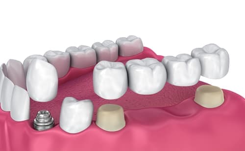 Лечение зубов вставка зуба