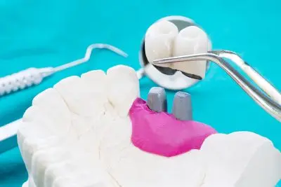 Имплантация позволяет восстановить зубные единицы без обточки соседних зубов.