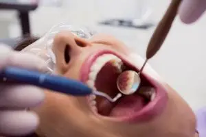 Качество пломбирования каналов зависит от используемых материалов и мастерства стоматолога.