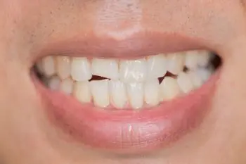 Щель между зубами