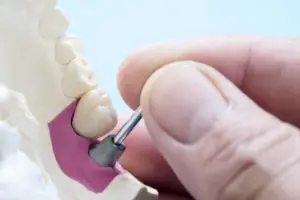 Как крепятся коронки к зубу