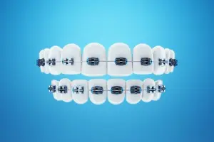 Виды несъемных ортодонтических аппаратов
