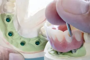 Виды протезирования при полном отсутствии зубов