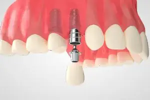 Имплантация верхних зубов по протоколу all-on-6
