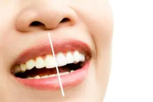 Домашнее отбеливание зубов капами – недорогой и достаточно эффективный метод восстановления белизны эмали.