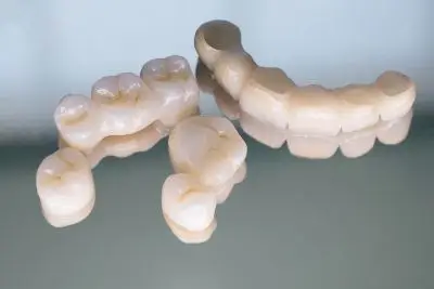 Изготовление мостовидного протеза в зуботехнической лаборатории.