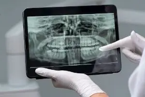 Перелечивание каналов зуба