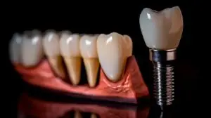 Преимущества экспресс имплантации зубов