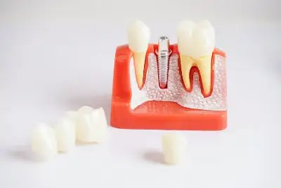 Одна из новейших методик протезирования зубов – керамика E.max.